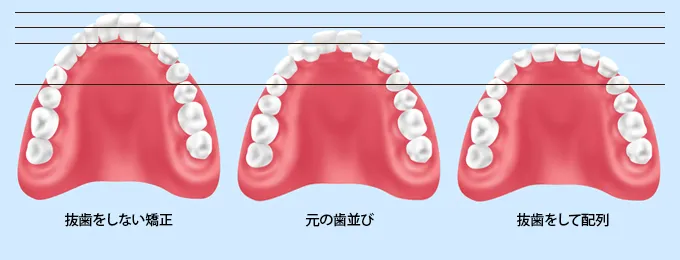 抜歯をする矯正比較