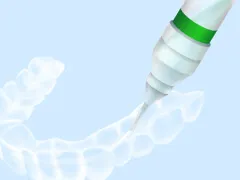 ホームホワイトニングの様子