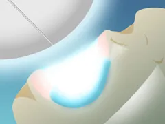 オフィスホワイトニングの様子
